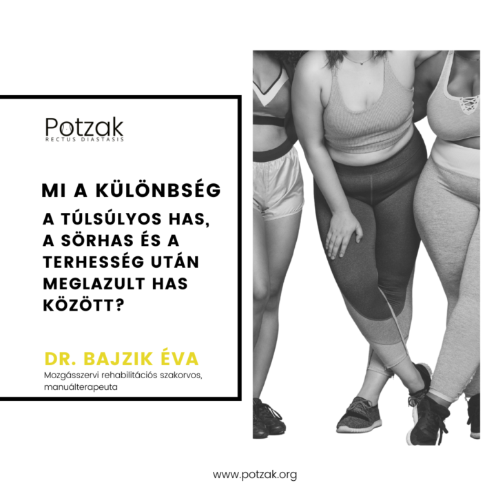 Potzak – Szétnyílt hasizom _ Mi a különbség a túlsúlyos has, a sörhas és a terhesség után meglazult has között_